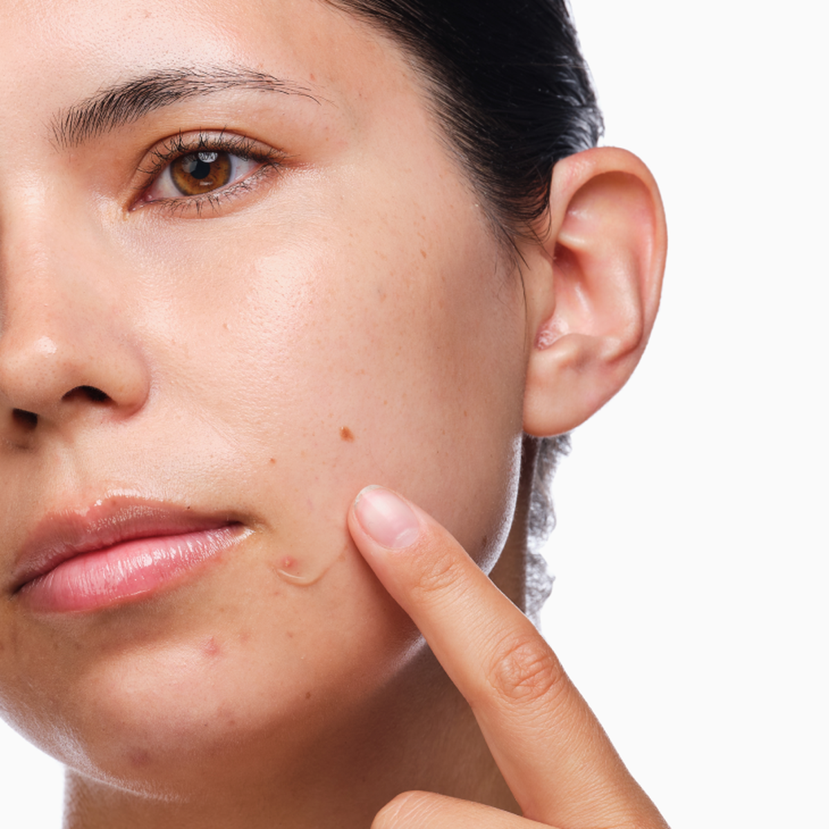 the-acne-set-q6 rdn-the-acne-set-application.png