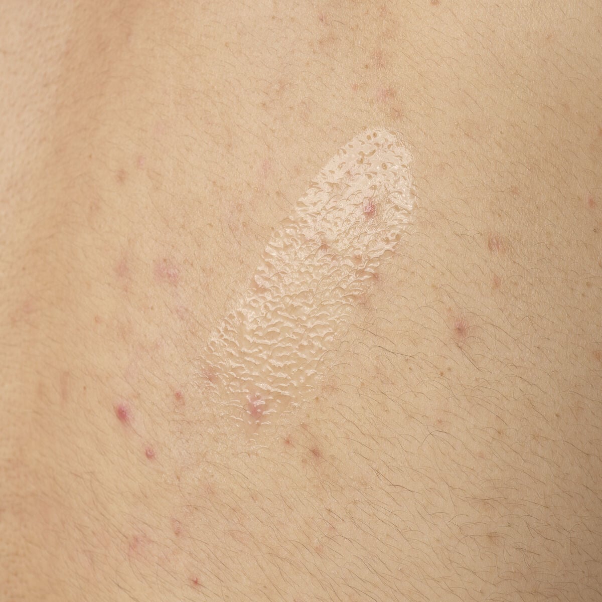 salicylic-acid-0-5-body-serum-c1 ORD-salicylic-acid-05-body-240ml-application.jpg