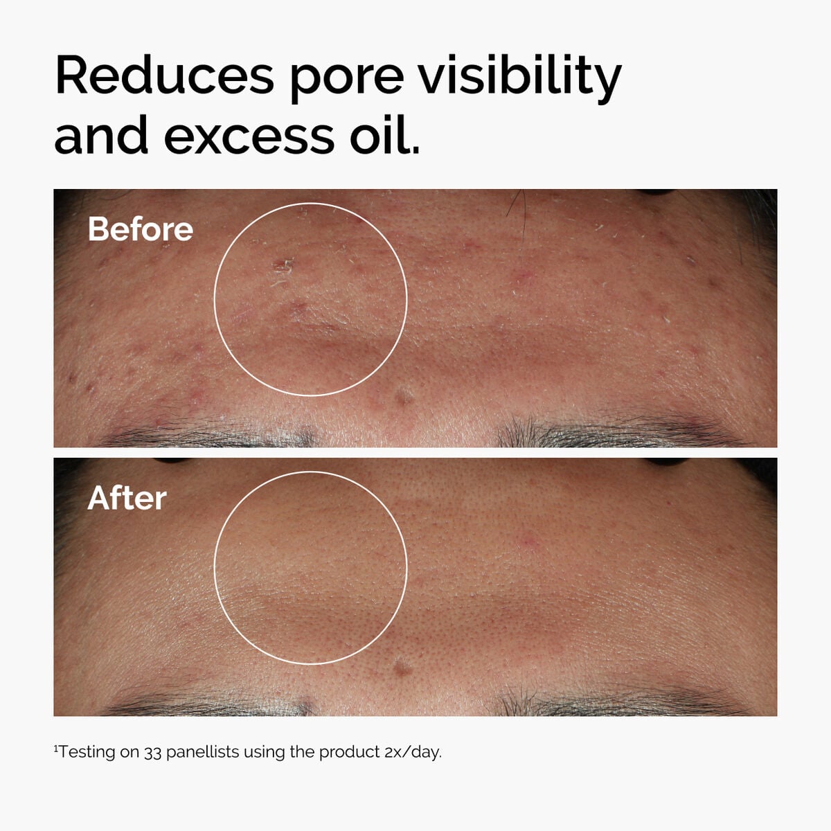 niacinamide-10-zinc-1-i0 ord-niacinamide-zinc-blemish-serum-before-after-pores.jpg