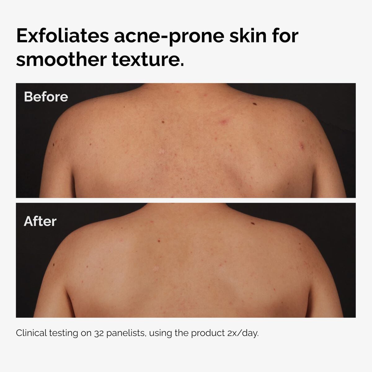 salicylic-acid-0-5-body-serum-m6 ord-salicylic-acid-body-serum-before-after-graphic-NA.jpg