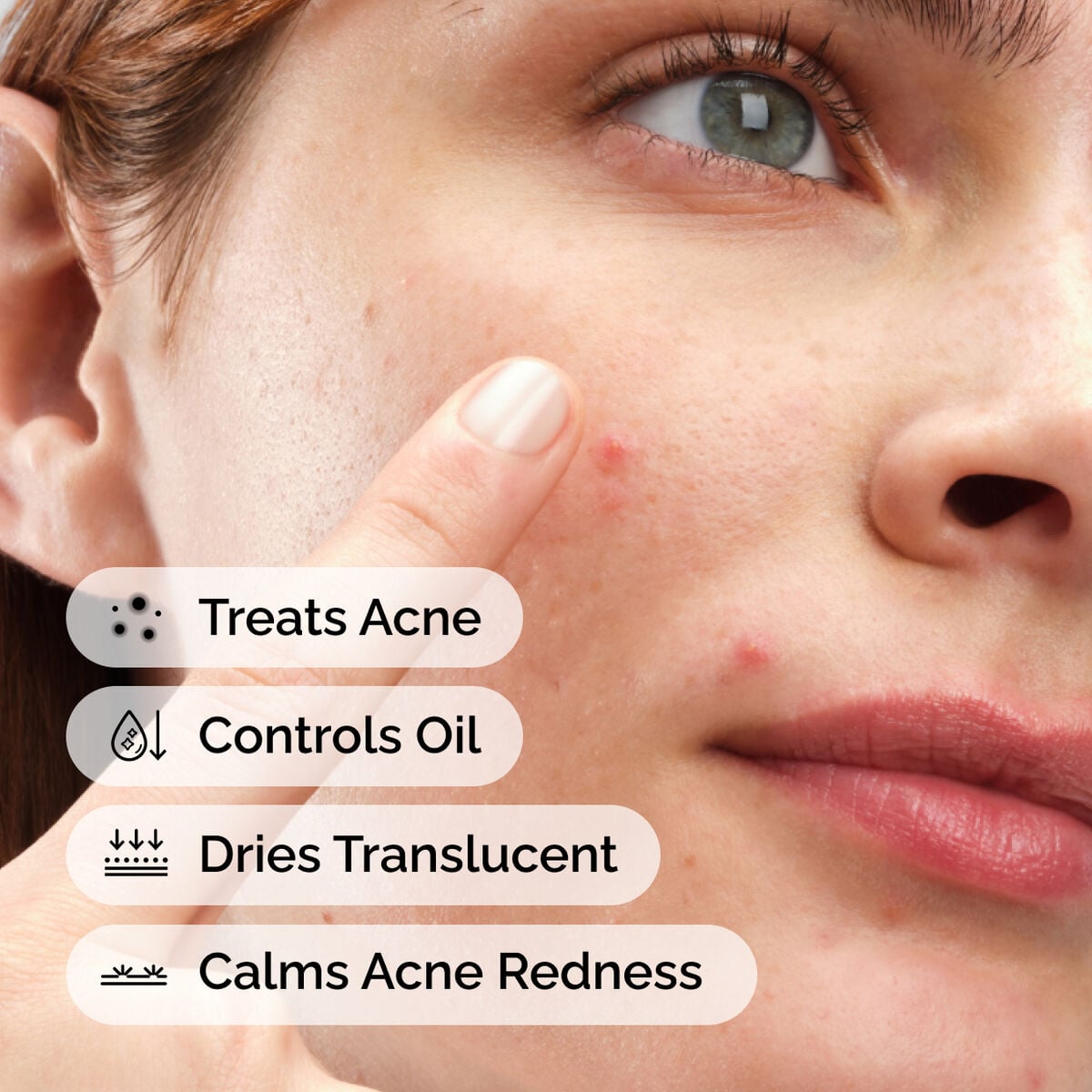 sulfur-10-powder-to-cream-concentrate-r9 ord-sulfur-10pct-powder-to-cream-concentrate-model-application-with-benefits-acne.jpg